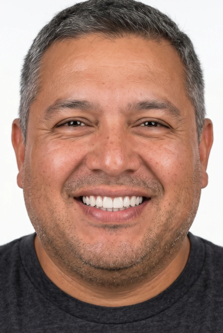 After — with porcelain veneers